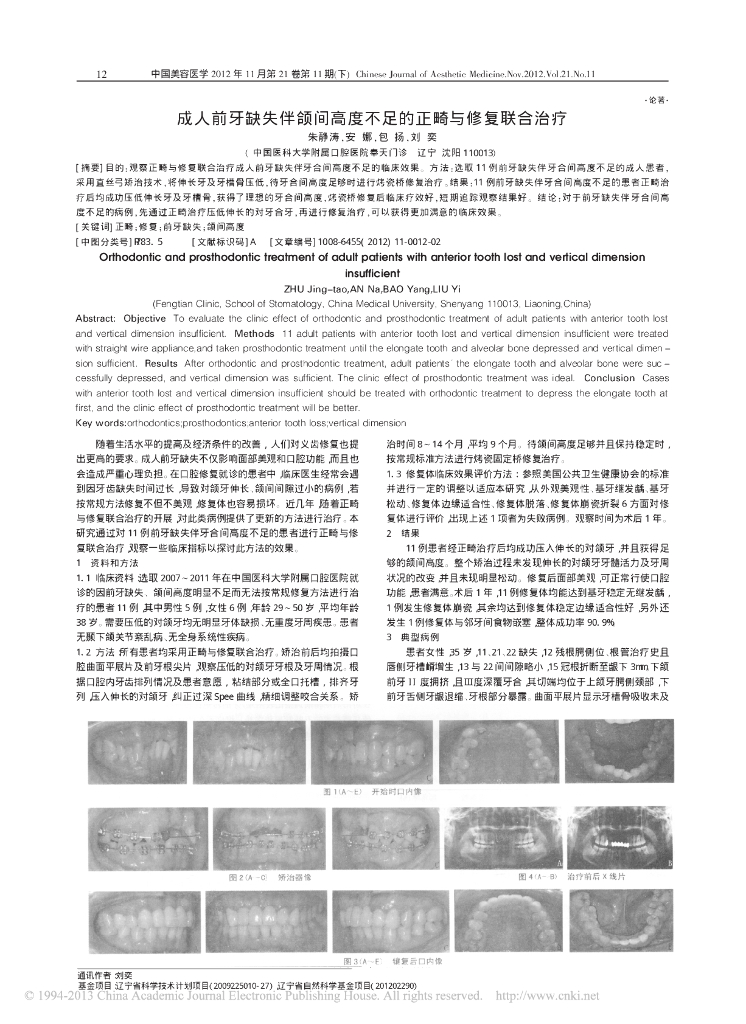 成人前牙缺失伴颌间高度不足的正畸与修复联合治疗