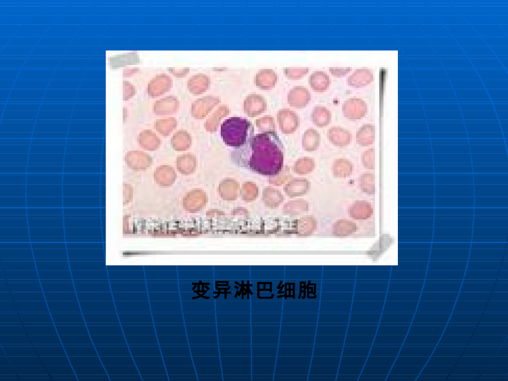 《儿科学》演示文稿-传染性单核细胞增多症2