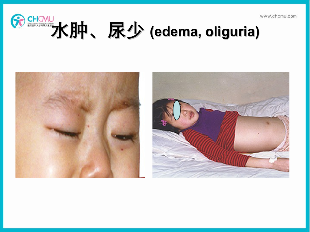 《儿科学》演示文稿-急性肾小球肾炎2