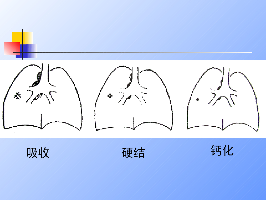 《儿科学》演示文稿-儿童结核病2（2015版）