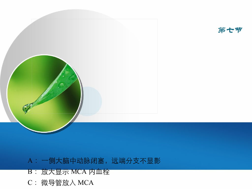 《放射诊断学》演示文稿-脑血管疾病 新