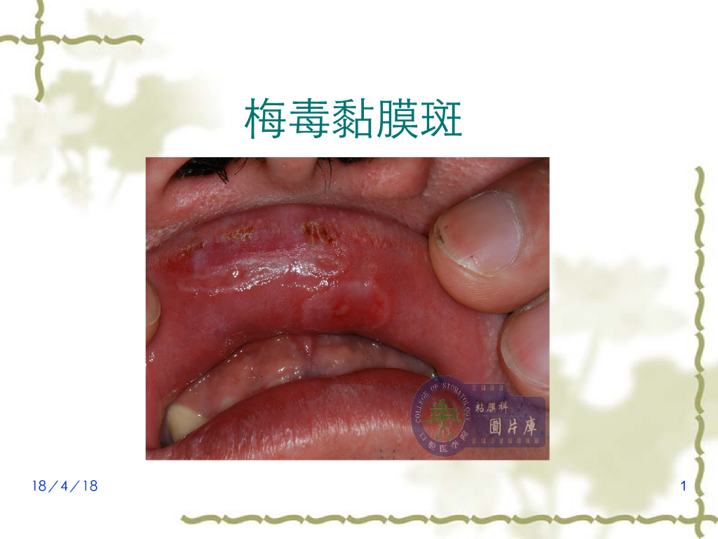 《口腔内科学》演示文稿-艾滋病