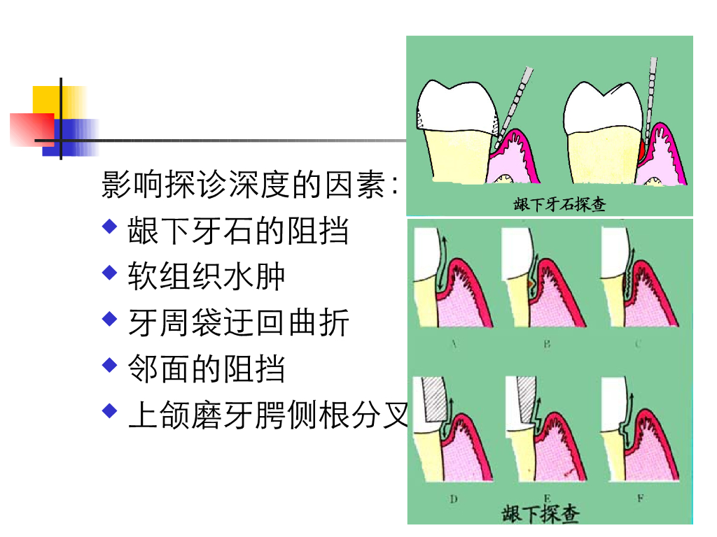 《口腔内科学》演示文稿-牙龈病1