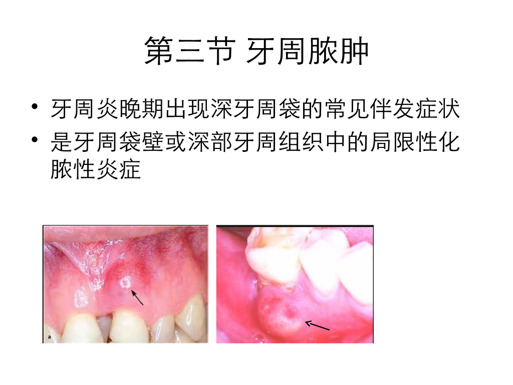 《口腔内科学》演示文稿-牙周炎的伴发病变（下）