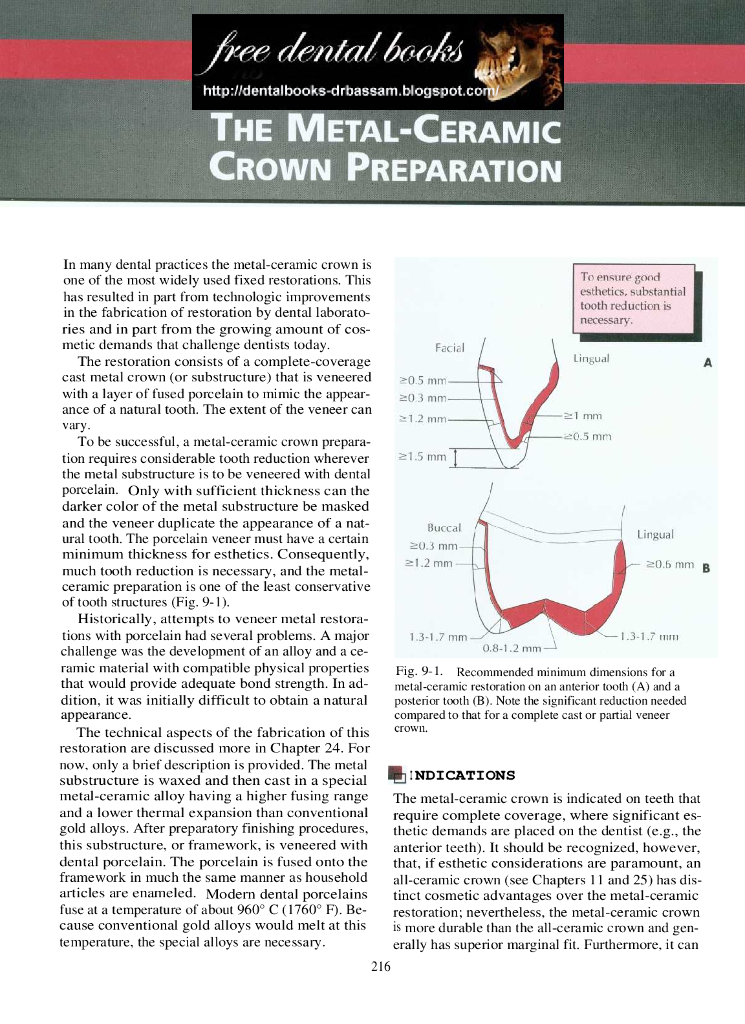 《口腔固定修复工艺技术》文献资料-烤瓷牙体预备 the metal-ceramic crown preparation