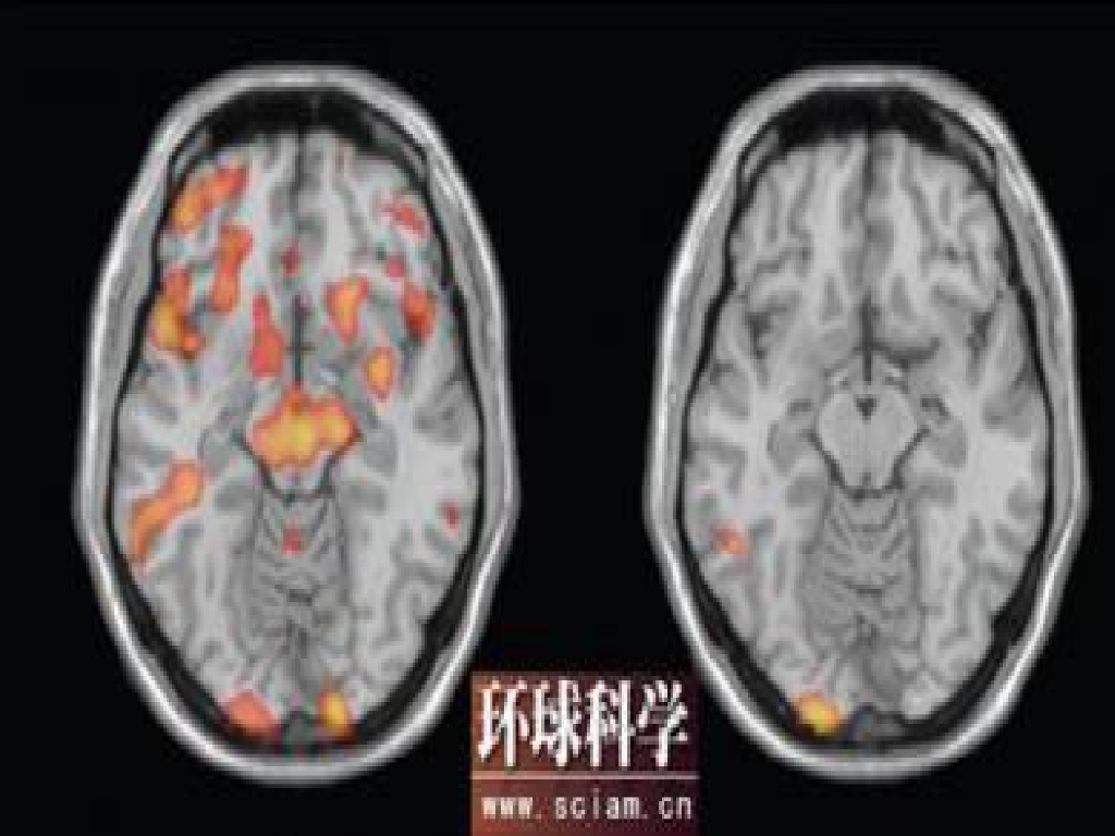 《现代医学成像技术》FMRI用于测谎研究的资料搜集与整理