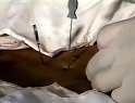 《针刀医学》教学片