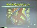 心衰与肺水肿的相互影响和联系