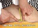 女性尿道综合征的中医电针疗法