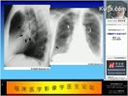 胸部X线平片读片方法教学