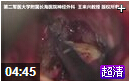 脑室内脑膜瘤的手术操作方法
