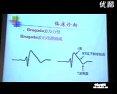 Brugada综合征的心电图诊断