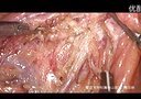 腹腔镜辅助右半结肠切除术的操作过程