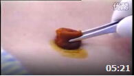 腹膜腔穿刺技术的临床操作
