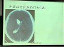 医学影像学-脑出血的CT.DSA分析
