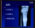 骨折的相关概论-中国医科大学贾长春