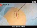 贺银成2012年执业医师资格考试实践技能-骨髓穿刺