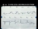 执业医师实践技能考试心电图部分和x线检查辅导