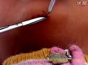 技能考试之外科手术拆线方法