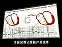 2013年执业医师考试 交界性逸搏的心电图诊断