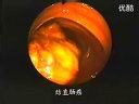 纤维结肠镜的操作诊疗技术教学片