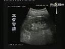 肾脏病变的超声医学诊断方法临床应用