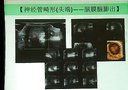 新生儿神经管闭合畸形超声识别及进展 深圳儿童医院