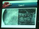 乳腺导管内癌的超声诊断方法讲课
