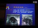 乳腺良恶性病变的超声诊断特点