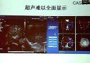 融合影像介入导航系统在肝肿瘤消融治疗中应用