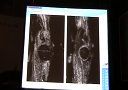 自动全容积乳腺扫查在肌肉骨骼系统的应用