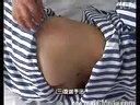 董氏手法治疗腰椎间盘突出症技术