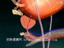 外科学课程-良性前列腺增生症