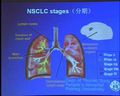 常见胸部肿瘤疾病的诊治方法 北京大学人民医院