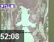 名医谈百病--防治喉癌