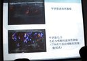 乳腺纤维腺瘤患者病例讨论