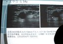 睾丸神经病例讨论专家讲解