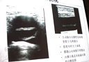 腹主动脉夹层的诊断和相关知识