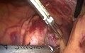 高清宫腹腔镜及工作站手术录制视频