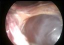 腹腔镜下左肾囊肿去顶减压术