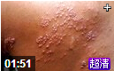 HerpesZosterorShingles带状疱疹