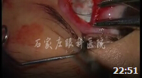 斜视的显微镜手术操作过程 眼科手术