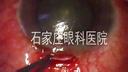 难治性青光眼的显微镜下手术操作过程