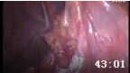 腹腔镜毕2式胃大部分切除术