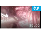 腹腔镜盆腔巨大粘连淋巴结切除手术