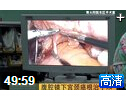 微创腹腔镜下宫颈癌根治术的手术过程