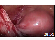 腹腔镜下卵巢内异囊肿剥除术