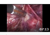 腹腔镜手术--妇科恶性肿瘤治疗