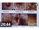 炎症性肠病诊断中的困惑与挑战