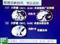 消化道肿瘤的4P医学离我们还很远吗